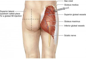How to inject Testosterone (TRT) into your glutes - Dosage May Vary